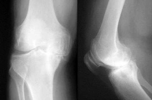 Osteoartriti Anlamak İçin Görsel Rehber