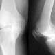 Osteoartriti Anlamak İçin Görsel Rehber