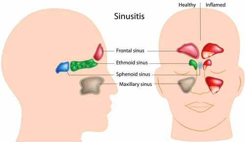 Sinüzit