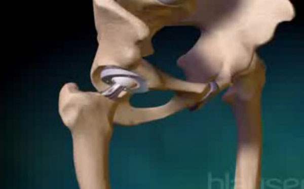 Osteoartrit