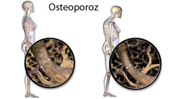 Osteoporoz (Kemik Erimesi)