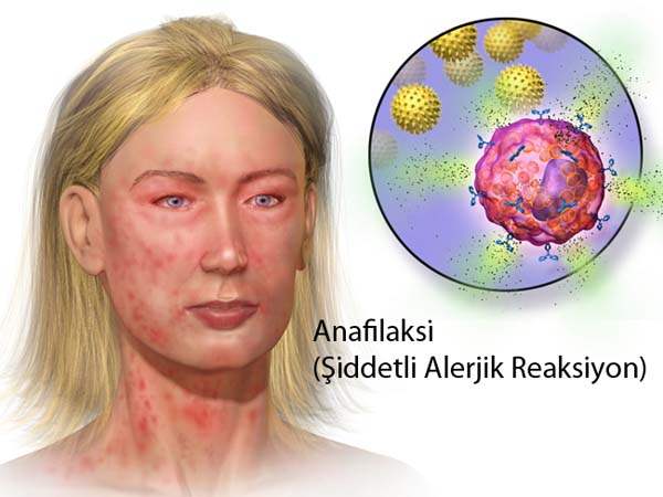 Anaflaksi (Şiddetli Alerjik Reaksiyon)