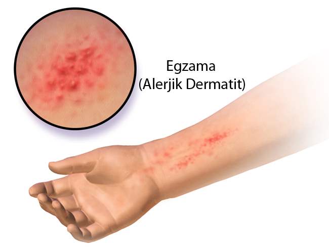 Dermatit  (Deri İltihabı)