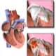 Endokardit (Kalp İç Zarı İltihabı)