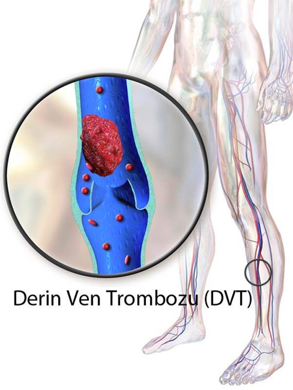 Derin Damar Trombozu