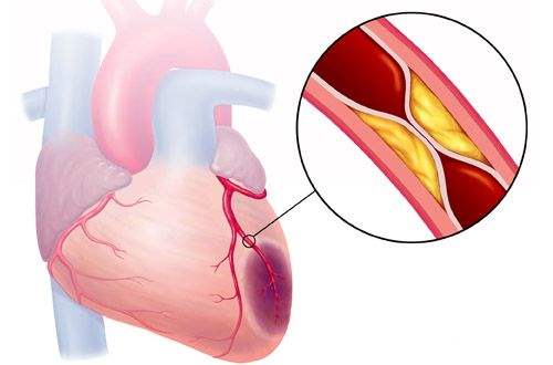Atrial Çarpıntı ve Atrial Çırpınım