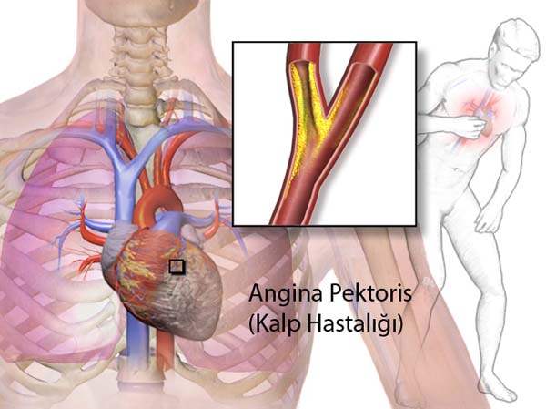 Kalp Hastalığı ve Angina (Göğüs Ağrısı)