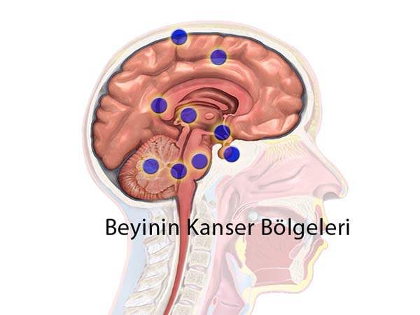 Beyin Kanseri Nasıl Önlenir