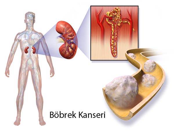 Böbrek Kanseri