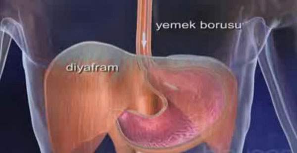 Yemek Borusu Kanseri
