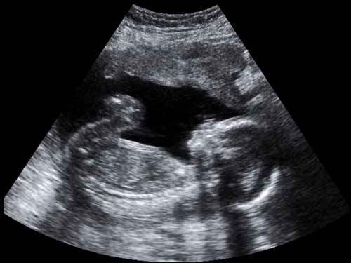 Fetal Ultrason