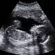 Fetal Ultrason