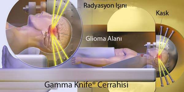 Gamma-Knife (Gamma Bıçağı) Radyo Cerrahi