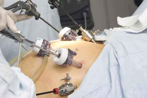 Gastrik Baypas Ameliyatı