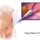 Pap Smear