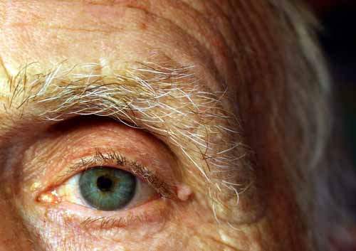 Diyabetik Göz Hastalığı (Retinopati)