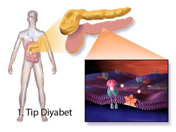 1. Tip Diyabet