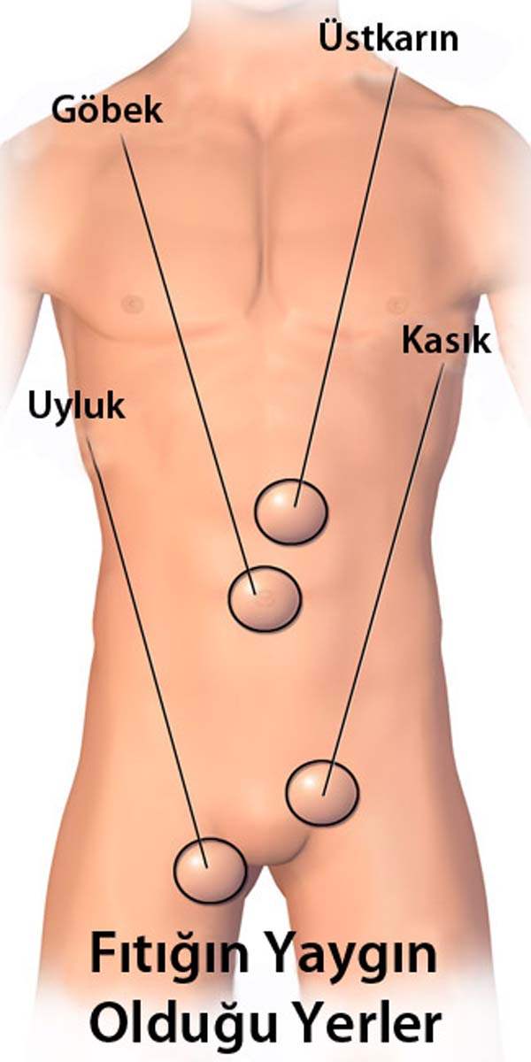 Göbek Fıtığı (Umblikal Herni)