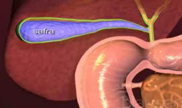 Safra Taşlarını Düşürmek İçin Ne Yapılmalı?