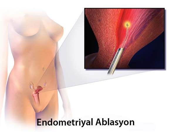 Endometriyal Ablasyon