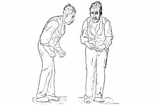 Parkinson