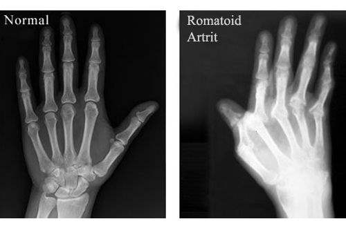 Romatoid Artrit için El Egzersizleri