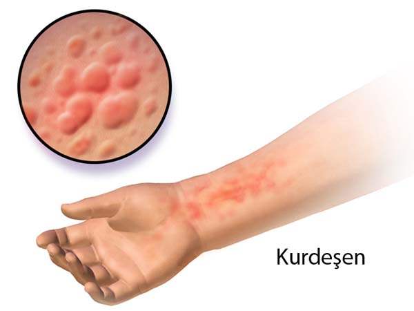 Gebelikte Kurdeşen