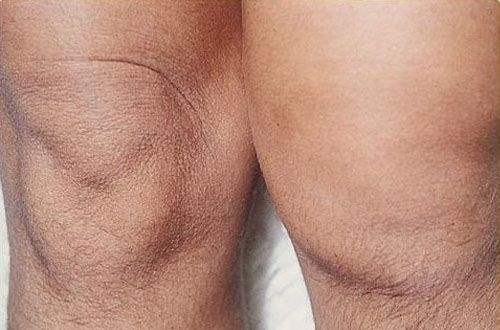Prepatellar Bursit