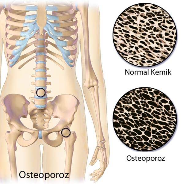 Osteoporozda Titreşim Egzersizleri