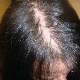 Saç Ekimi Ameliyatı: Saç Dökülmesine Kalıcı Çözüm
