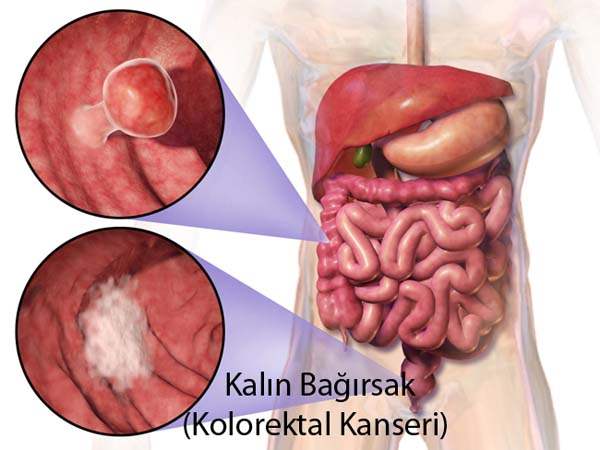 Anal Kanser