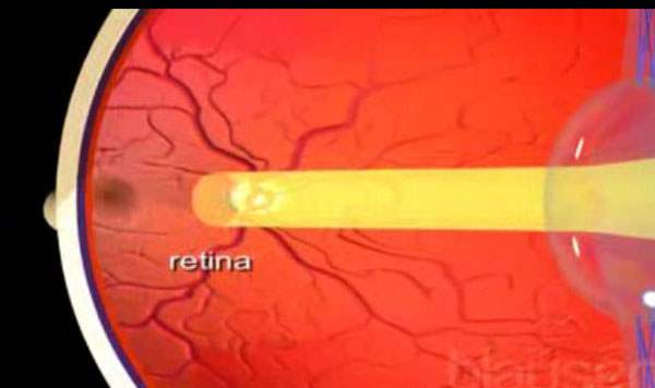 Retinoblastom (Retina Kanseri)