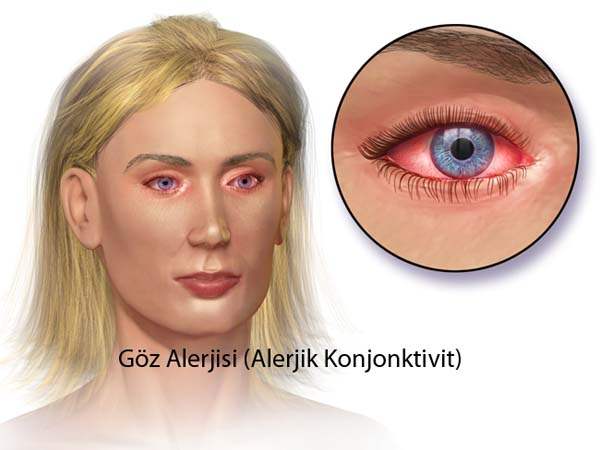 Konjunktiva İltihapları