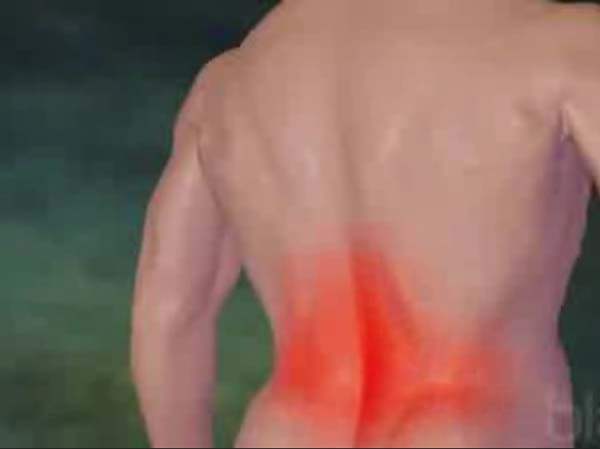 Bel Fıtığı (Disk Hernisi - Hernia Diskal)