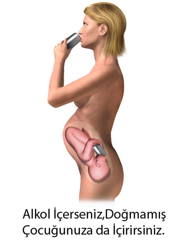 Fetal Alkol Sendromu