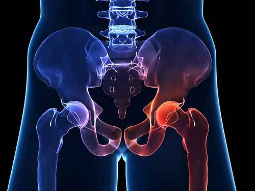 Aortoiliak Tıkayıcı Hastalık (Leriche Sendromu)