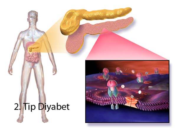 Tip-2 Diyabet Hastaların Yaşam Kalitesini Düşürüyor