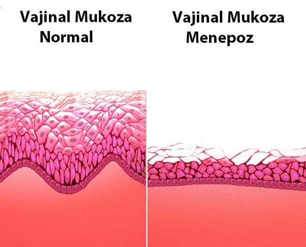 Bakteriyel Vajinozis