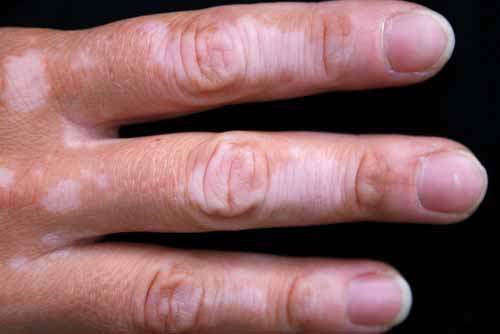 Akderi (Vitiligo)