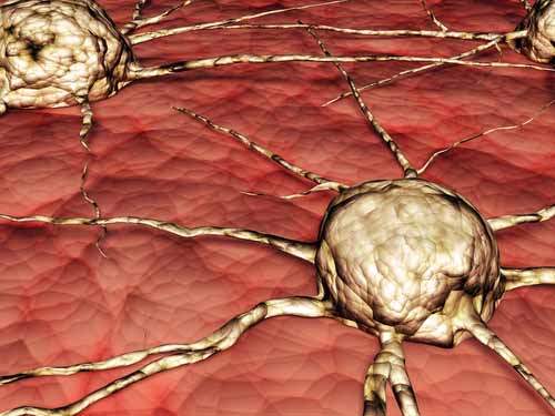 Glioblastoma Multiform