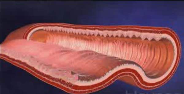 Bağırsakta Lenf Kanalları Genişlemesi (İntestinal Lenfanjiektazi)