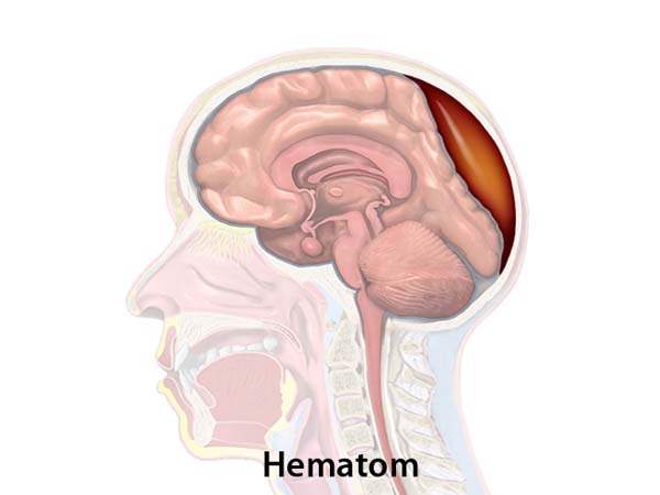 İntrakraniyal hematom