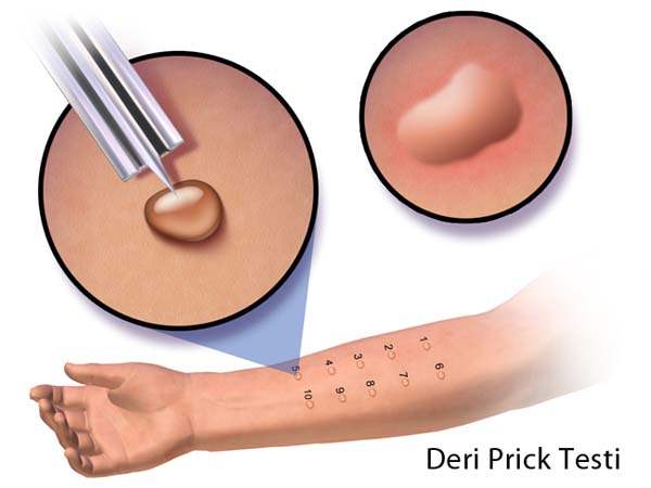 Dermoid Kist