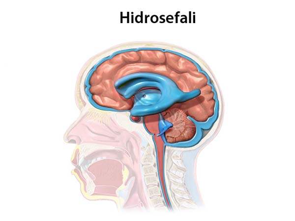 Normal Basınçlı Hidrosefali