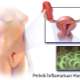 Pelvik Enflamatuar Hastalık (PEH)