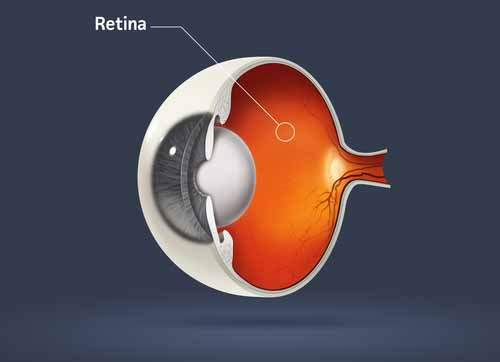 Pigmenter Retinopati