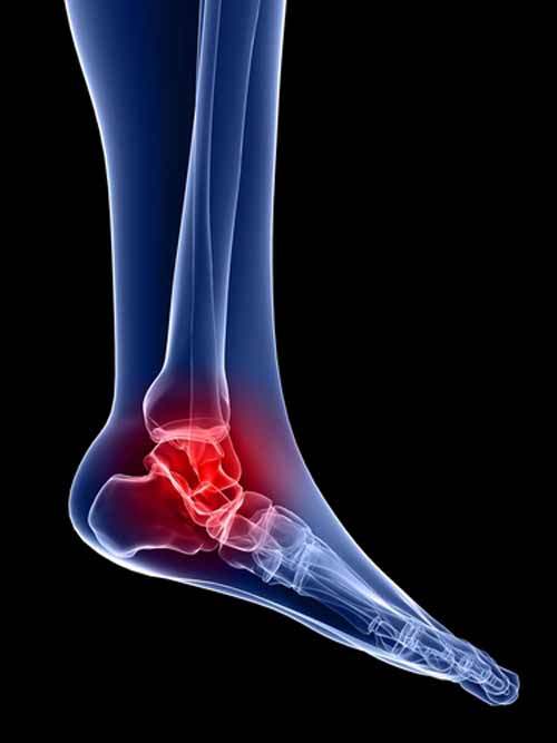 Tarsal Tünel Hastalığı