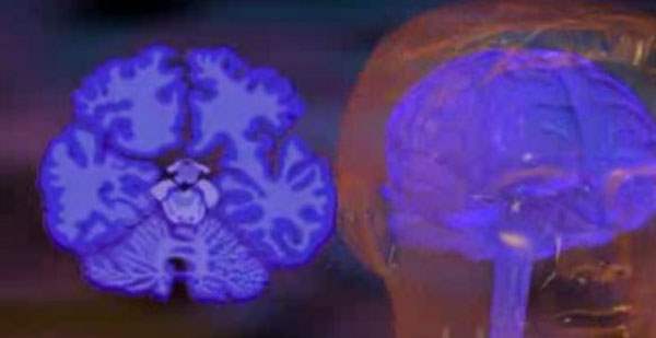 Parkinson Hastalığında Demans