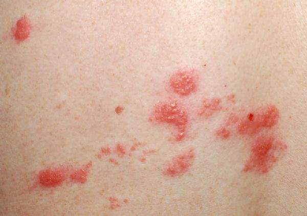 Zona (Herpes Zoster)