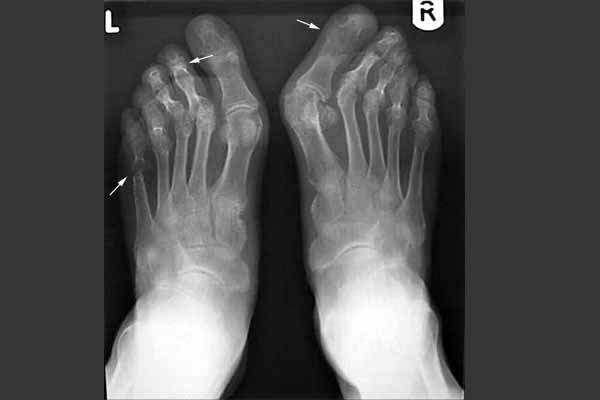 Halluks Valgus